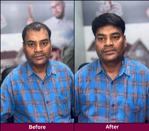 Hair Replacement