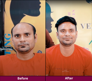 Hair Replacement
