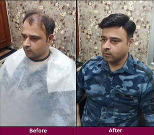 Hair Replacement