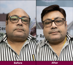 Hair Replacement