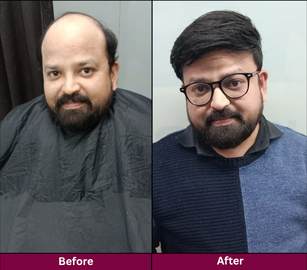 Hair Replacement