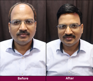 Hair Replacement