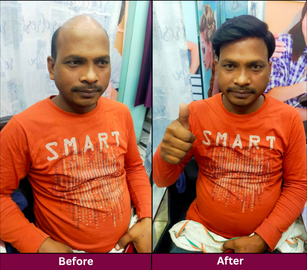 Hair Replacement
