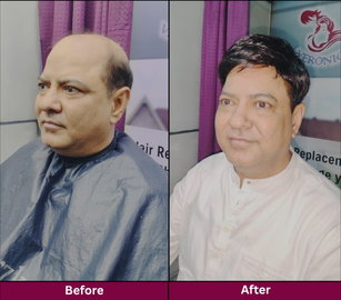 Hair Replacement