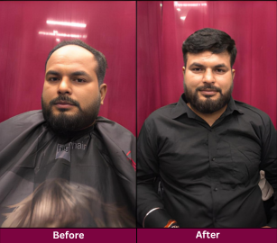 Hair Replacement